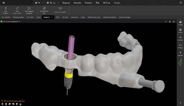 DTXStudioClinic surgicaltemplatewithimplant 3