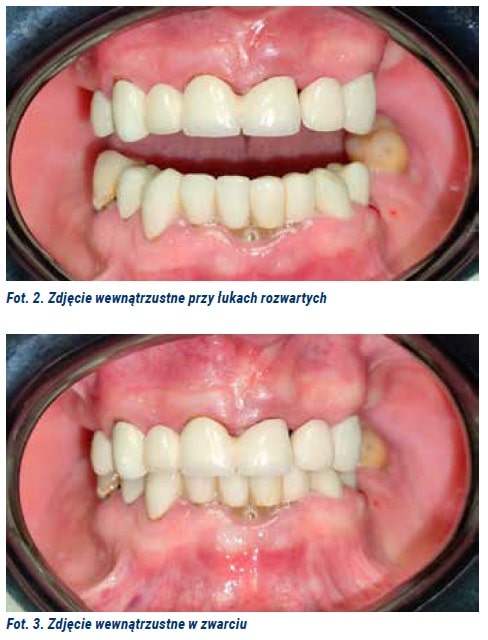 Odbudowa łuków zębowych 2